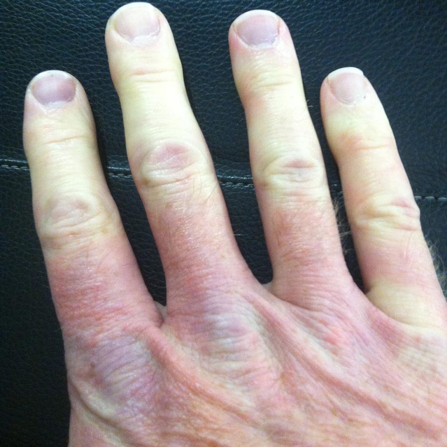 Multicolor_Raynaud's_Right_Hand